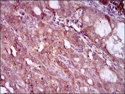 EGFR mutant